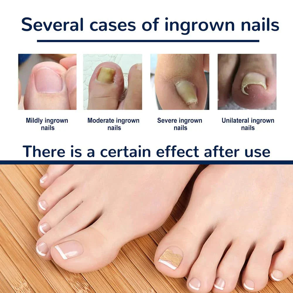 NagelVital Pro - Pflegeaufkleber für Nagelkorrekturen | 50% RABATT