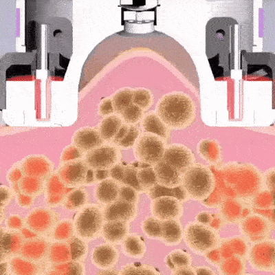 Cupnova 12 levels – Anti-Cellulite Massagegerät für schnelle Ergebnisse
