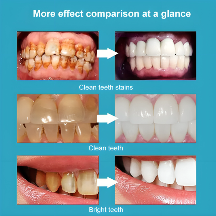 BrightSmile™ Zahnaufhellungs-Stift | 1+1 GRATIS